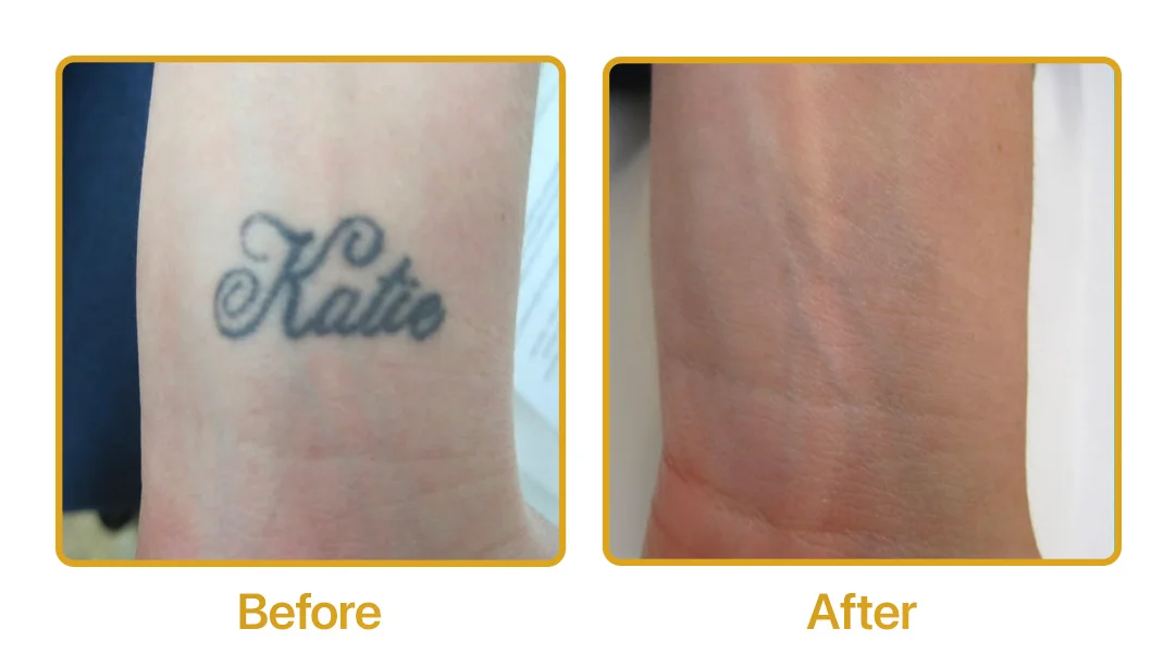 laser tattoo removal before and after