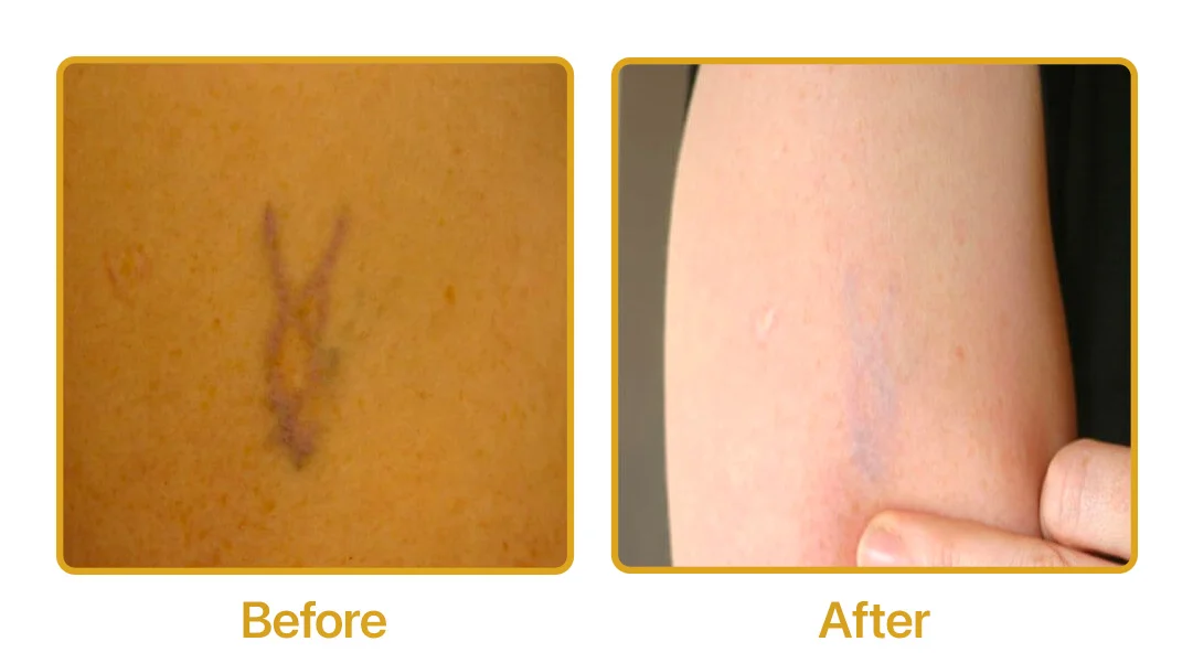 tattoo removal process transformation
