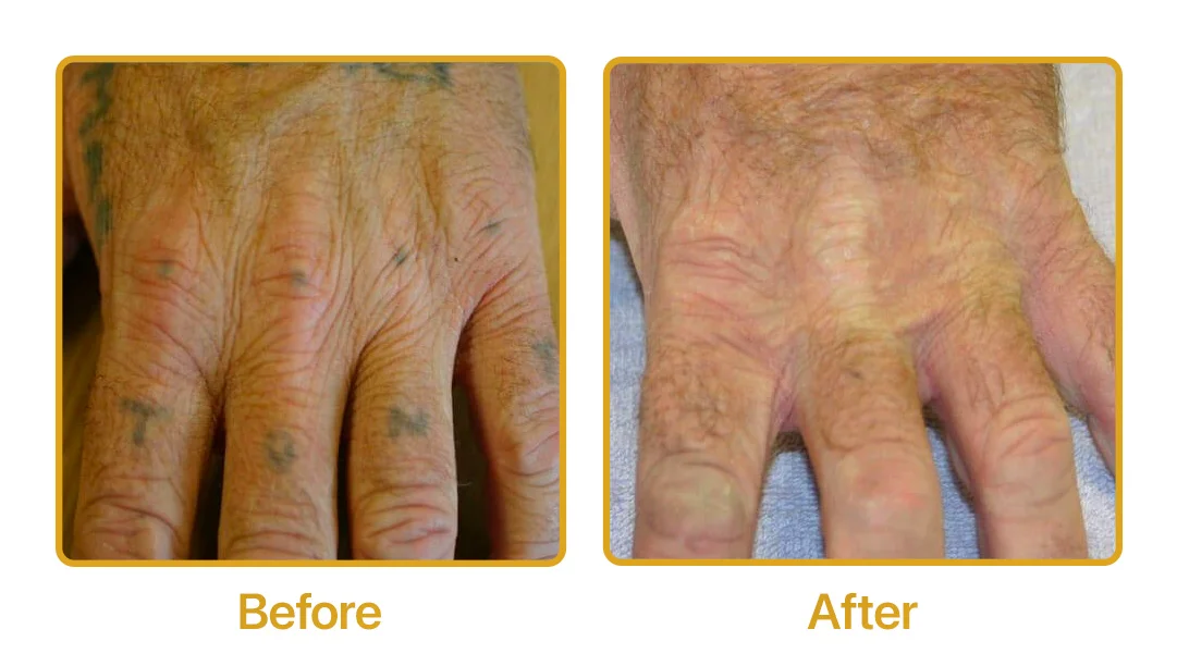 laser tattoo removal transformation
