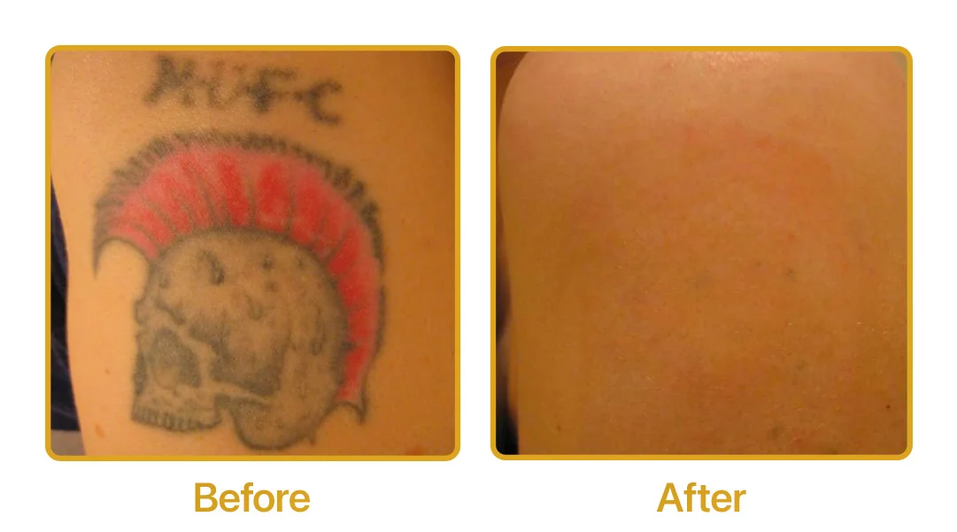 laser tattoo removal side by side